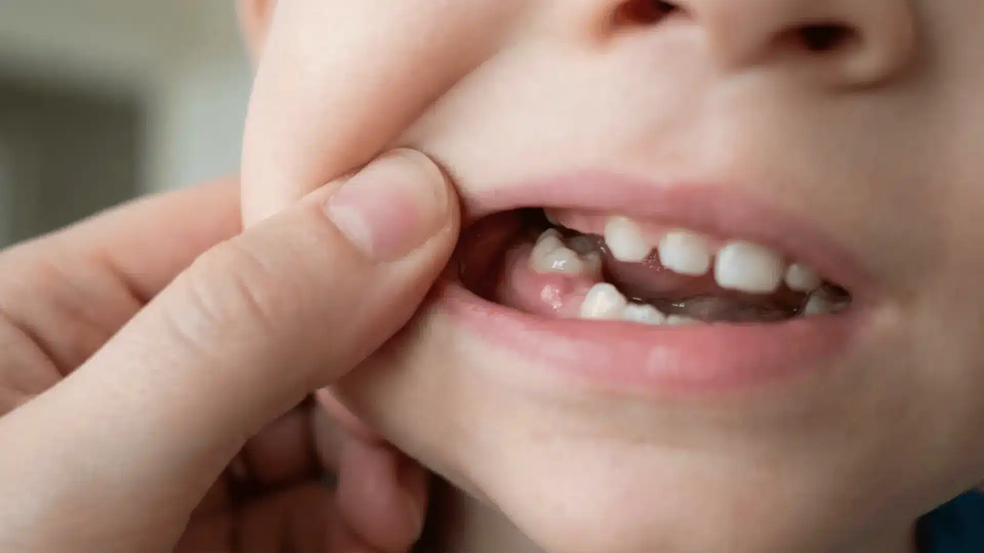 Close-up of toddler’s back gum showing early molar swelling and eruption signs