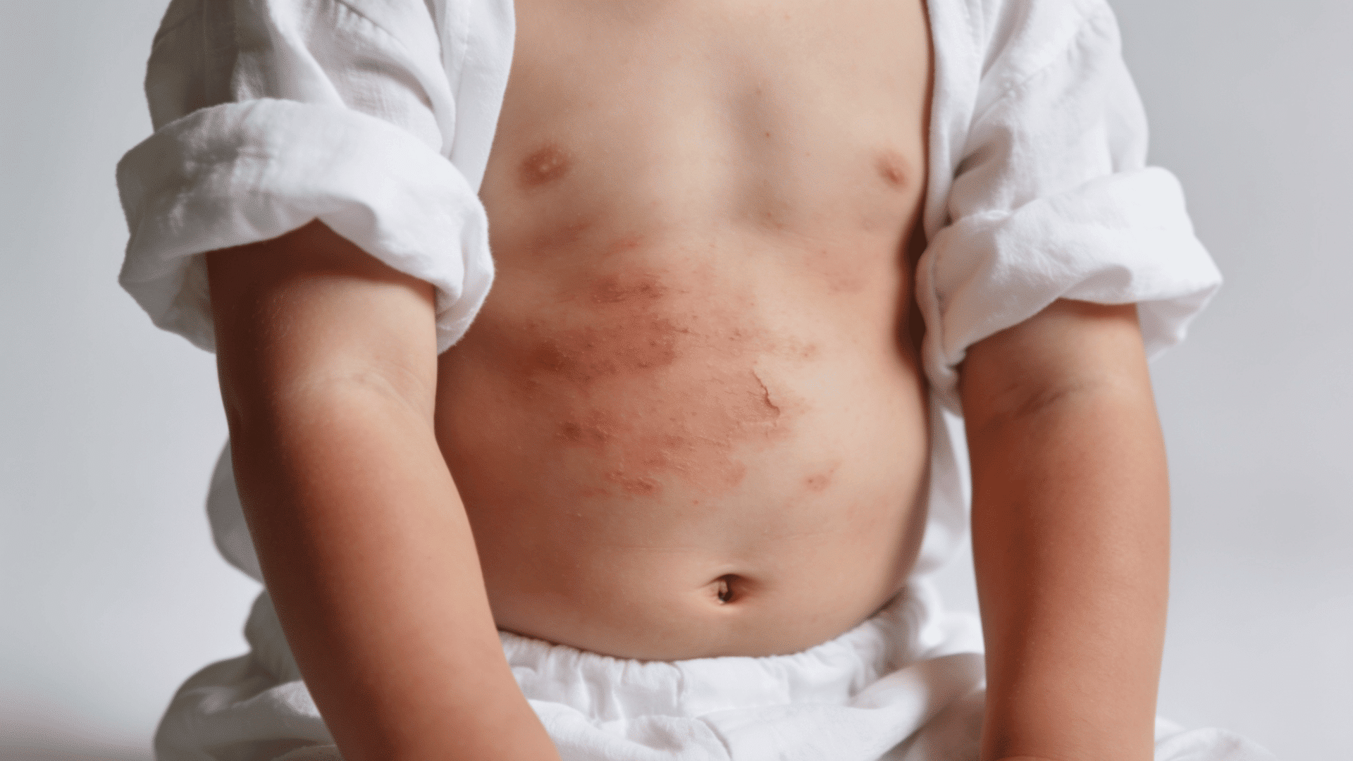 Child showing red irritated skin rash patches on the torso with dry peeling areas visible on the body